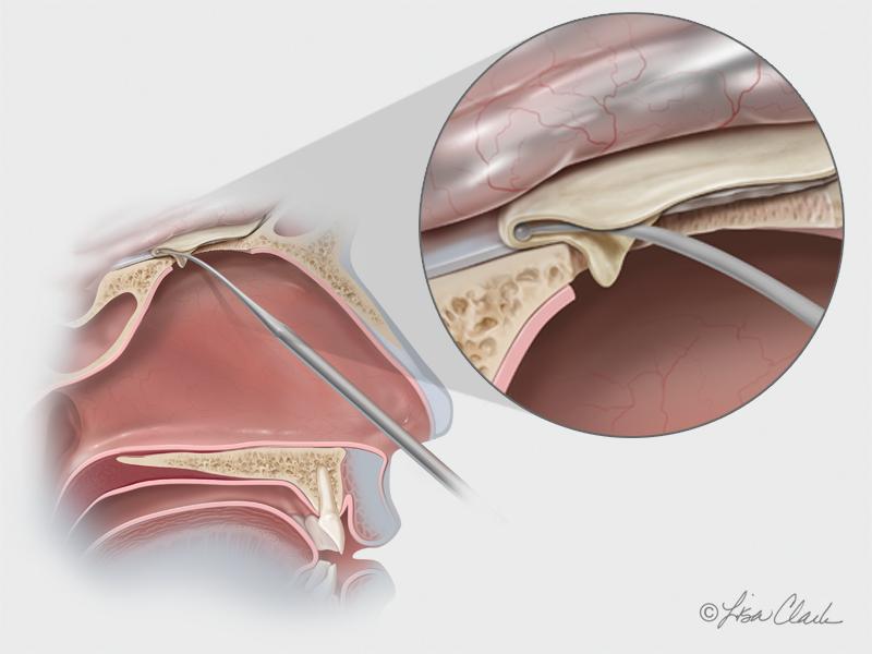 COOK Biodesign® Dural Graft