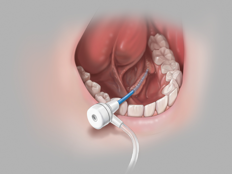 COOK Sialendoscopy