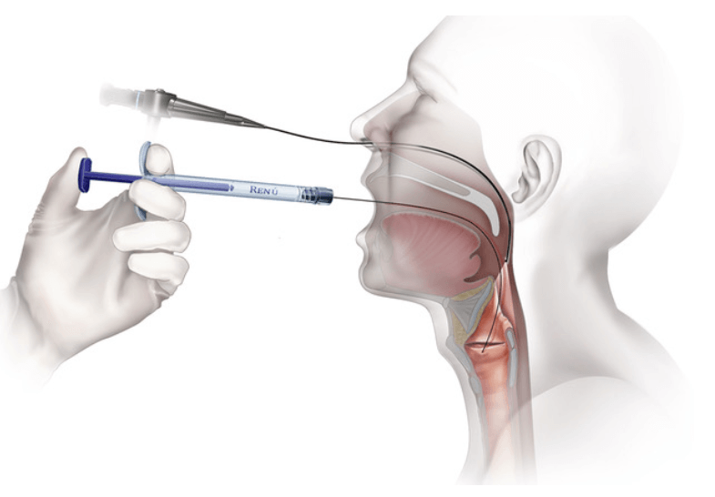 throat injections