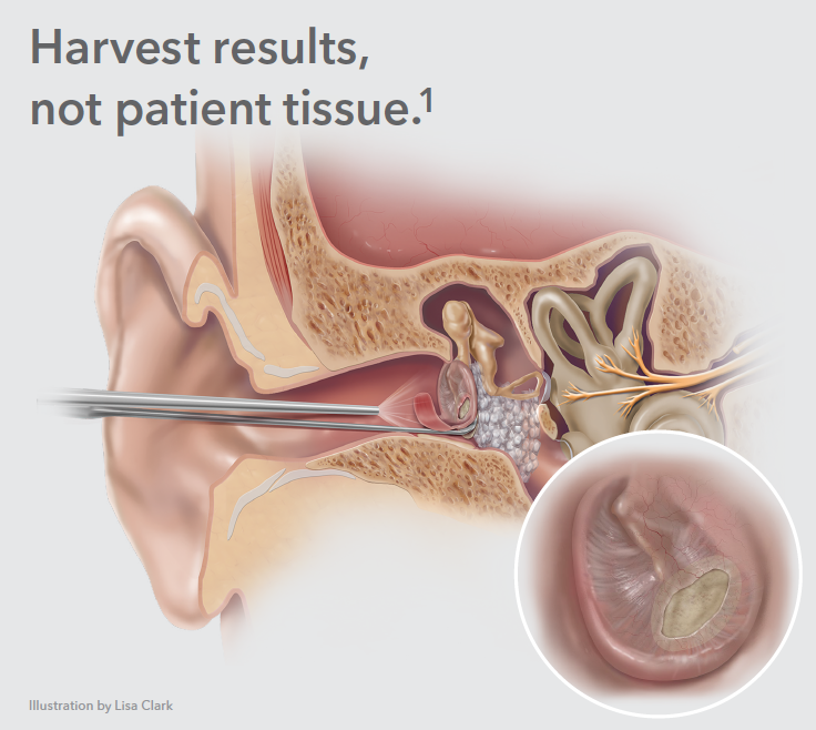 COOK Biodesign® Otologic Repair Graft